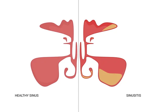 Illustration Friska Och Inflammerade Paranasala Bihålor Vit Bakgrund — Stockfoto