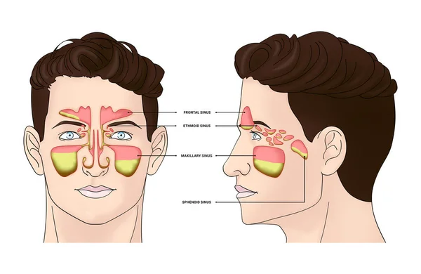 Ilustración Del Hombre Con Senos Paranasales Inflamados Sobre Fondo Blanco —  Fotos de Stock