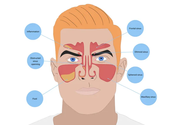 Illustration Man Med Friska Och Inflammerade Paranasala Bihålor Vit Bakgrund — Stockfoto