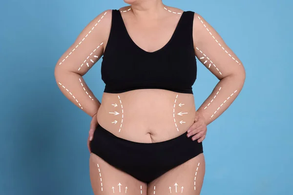 Vrouw Met Tekens Het Lichaam Voor Cosmetische Chirurgie Operatie Lichtblauwe — Stockfoto