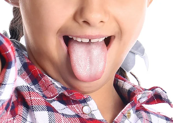 Menina Mostrando Língua Com Manchas Brancas Close Candidíase Oral Tordo — Fotografia de Stock