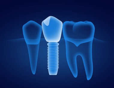 Koyu mavi arka planda diş ve diş implantı.