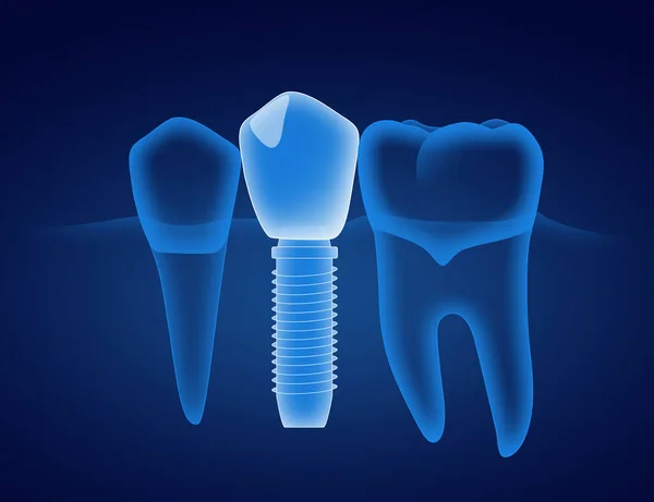 Ilustracja Zębów Implantów Stomatologicznych Ciemnoniebieskim Tle — Zdjęcie stockowe