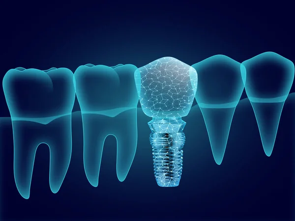 Illustration Von Zähnen Und Zahnimplantat Auf Dunkelblauem Hintergrund — Stockfoto