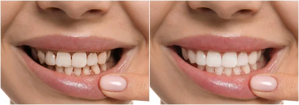 Collage Con Foto Giovane Donna Prima Dopo Trattamento Dentale Primo — Foto Stock