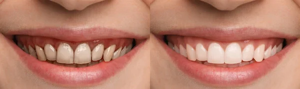 Κολάζ Φωτογραφίες Νεαρής Γυναίκας Πριν Και Μετά Την Οδοντιατρική Θεραπεία — Φωτογραφία Αρχείου