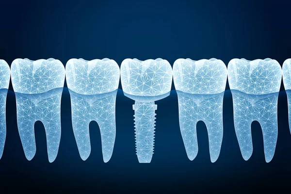 Illustration Von Zähnen Und Zahnimplantat Auf Dunkelblauem Hintergrund — Stockfoto