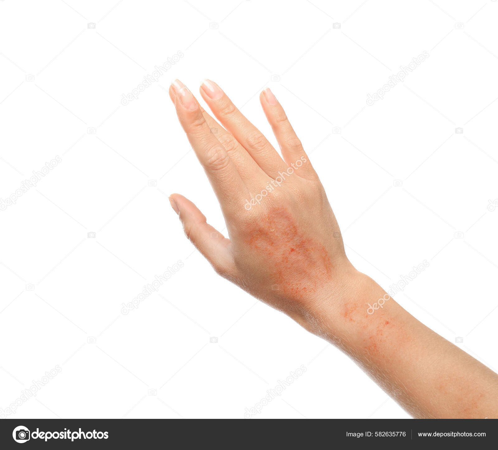 Red Rash Wrist Isolated White Background Rashes Skin Caused