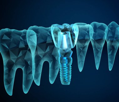 Koyu mavi arka planda diş ve diş implantı.