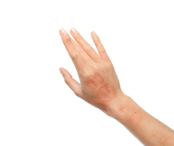 Vrouw Met Droge Hand Witte Achtergrond Close — Stockfoto