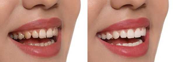 Collage Con Fotos Mujer Joven Antes Después Del Tratamiento Dental — Foto de Stock