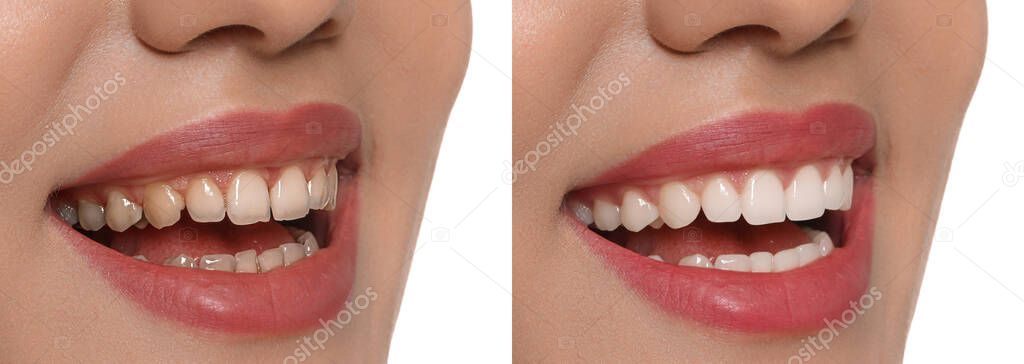 Collage with photos of young woman before and after dental treatment on white background, closeup. Banner design