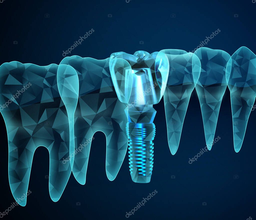 Illustration of teeth and dental implant on dark blue background