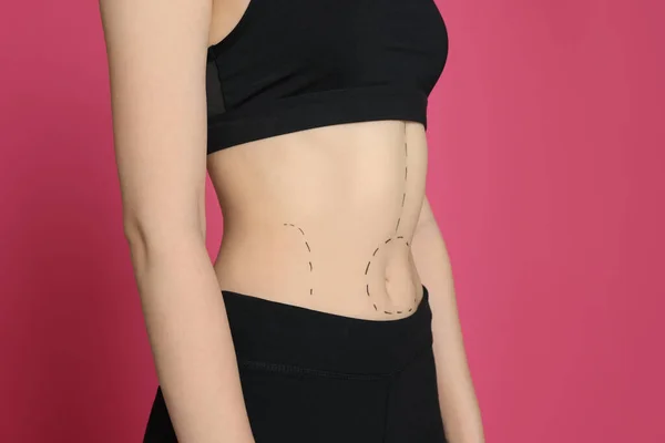身体上有粉红背景痕迹的瘦女人 体重减轻手术 — 图库照片