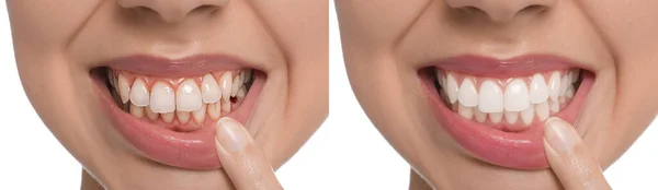 白の背景に歯科治療前後の若い女性の写真とコラージュ クローズアップ バナーデザイン — ストック写真