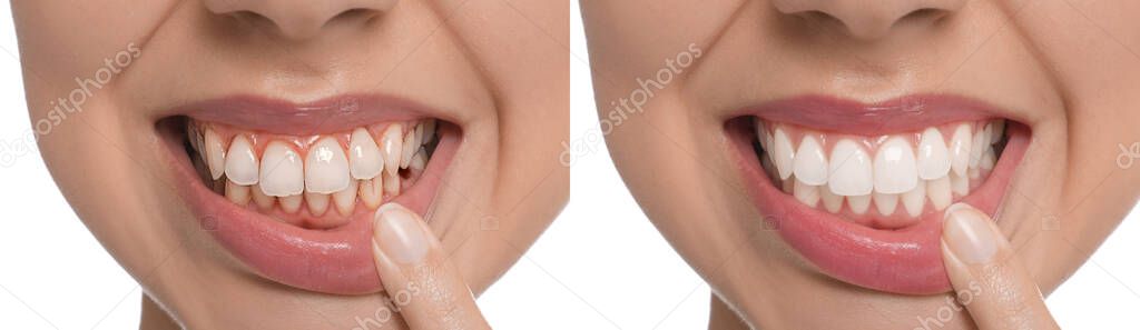 Collage with photos of young woman before and after dental treatment on white background, closeup. Banner design