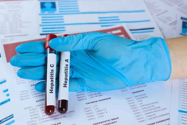 Laboratóriumi Formák Közelkép Kimutatására Szolgáló Vérmintákkal Ellátott Csöveket Tartó Tudós — Stock Fotó