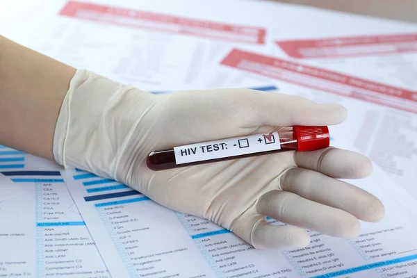 Scientifique Tenant Tube Avec Échantillon Sang Étiquetant Hiv Test Contre — Photo