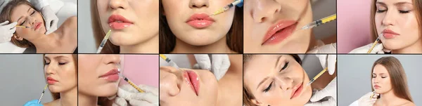 Collage Photos Woman Lip Augmentation Procedure Banner Design — 스톡 사진