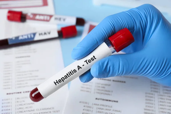 Scientist Holding Tube Blood Sample Label Hepatitis Test Laboratory Form — 图库照片
