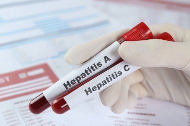 Laboratuvar formlarına karşı hepatit virüsü testi için kan örnekleri taşıyan bir bilim adamı.