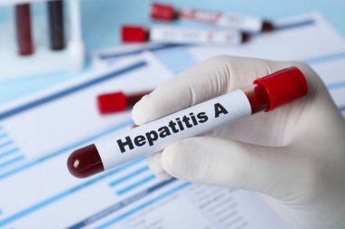 Bilim adamlarının elinde kan örneği ve Hepatit etiketi var. Laboratuvar test formuna yakın, yakın çekim.