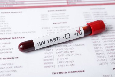Kan örneği içeren tüp ve laboratuvar formunda HIV testi etiketi, yakın plan.