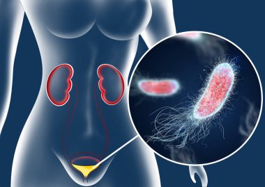 Illustration of woman suffering from cystitis. Urinary infection