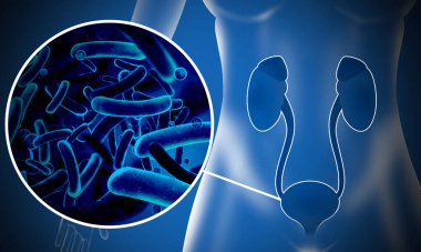 Illustration of woman suffering from cystitis. Urinary infection