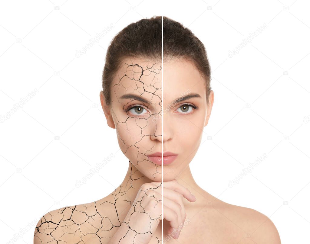 Collage with photos of woman having dry skin problem before and after dry skin problem on white background