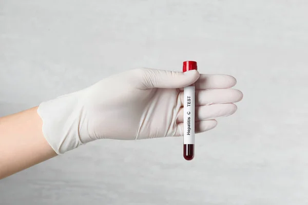 Scientist Holding Tube Blood Sample Label Hepatitis Light Background Closeup — 스톡 사진