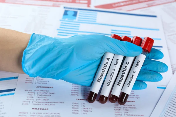 Laboratóriumi Formák Közelkép Kimutatására Szolgáló Vérmintákkal Ellátott Csöveket Tartó Tudós — Stock Fotó