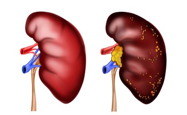 Illustration of healthy and diseased kidneys on white background