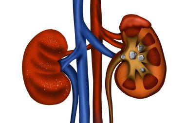 Illustration of healthy and diseased kidneys on white background