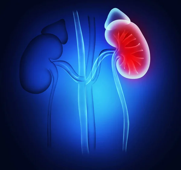 Illustration Healthy Inflamed Kidneys Blue Background — Photo