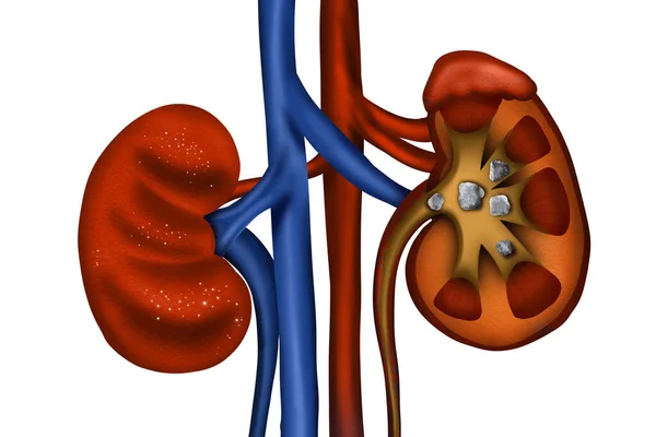 Illustration Healthy Diseased Kidneys White Background — Stok fotoğraf