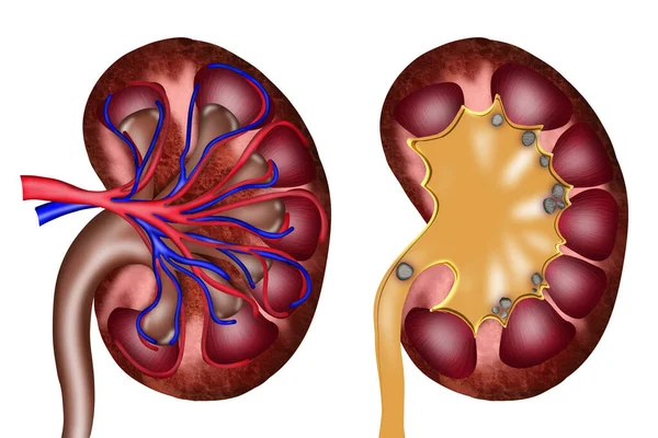 Illustration Healthy Diseased Kidneys White Background — Photo