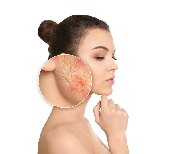 Young Woman Facial Dry Skin Problem White Background — Foto de Stock