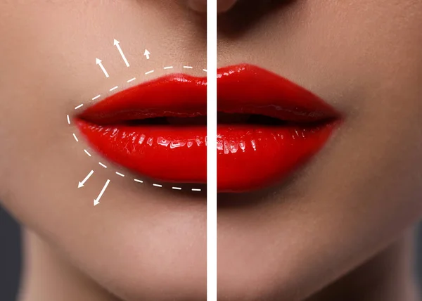 Collage Photos Young Woman Lips Augmentation Procedure Closeup — 스톡 사진