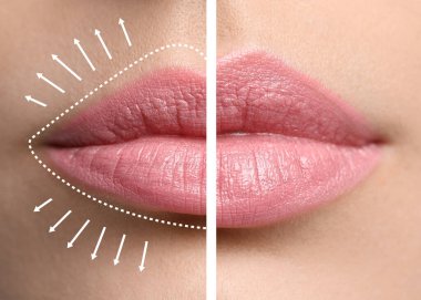 Collage with photos of young woman before and after lips augmentation procedure, closeup