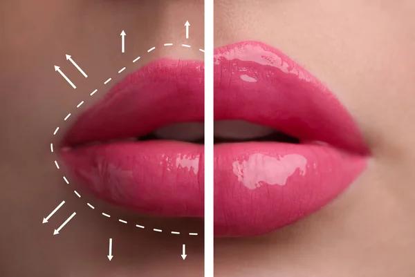 Collage Photos Young Woman Lips Augmentation Procedure Closeup — Stock Fotó
