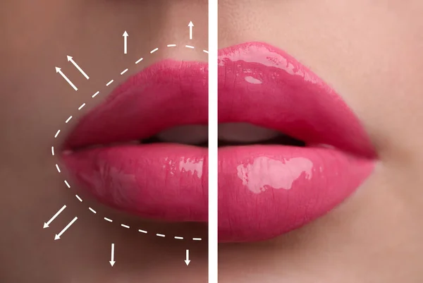 Collage Photos Young Woman Lips Augmentation Procedure Closeup — Stockfoto