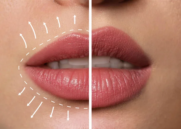 Collage Photos Young Woman Lips Augmentation Procedure Closeup — Stock Fotó