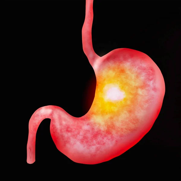 Illustration Diseased Stomach Black Background Gastroenterology — Stockfoto