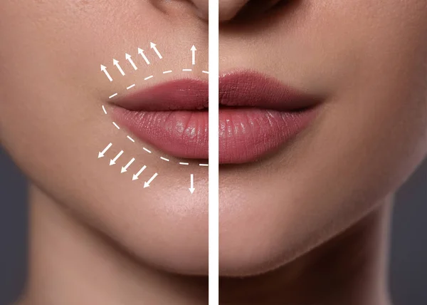Collage Photos Young Woman Lips Augmentation Procedure Closeup — Stockfoto