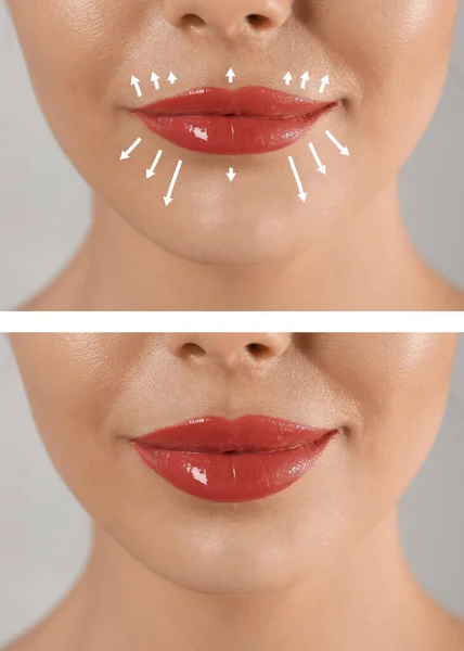 Collage Photos Young Woman Lips Augmentation Procedure Closeup — 스톡 사진