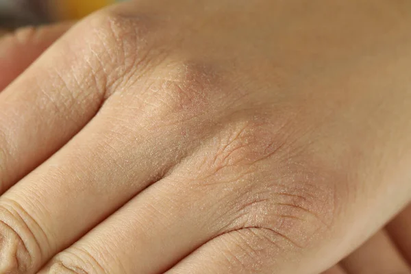 Closeup View Person Dry Skin Hand — 图库照片