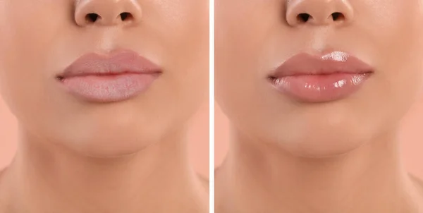 Collage Photos Woman Dry Moisturized Lips Closeup Banner Design — стоковое фото