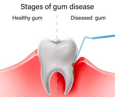 Collage with illustrations of healthy tooth with gum and diseased ones. Gingivitis and periodontitis