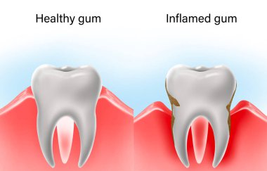 Collage with illustrations of healthy tooth with gum and diseased ones. Gingivitis and periodontitis
